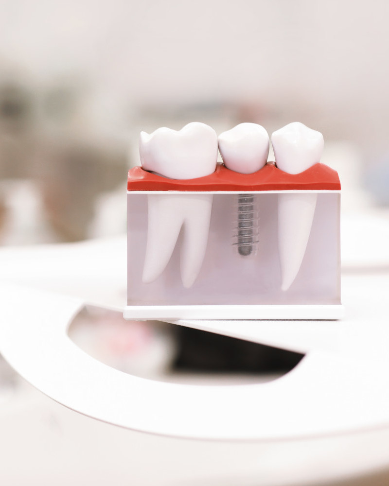 implant unitaire
